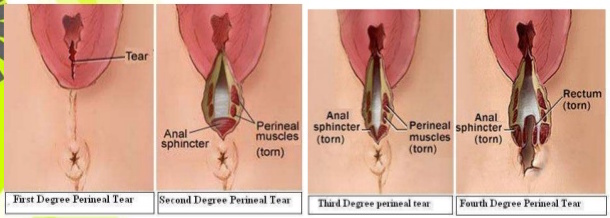 Slide show: Vaginal tears in childbirth - Mayo Clinic